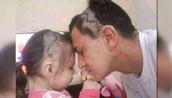 ब्रेन सर्जरी के बाद बेटी दिखने लगी ऐसी तो पापा ने किया दिल छू लेने वाला काम