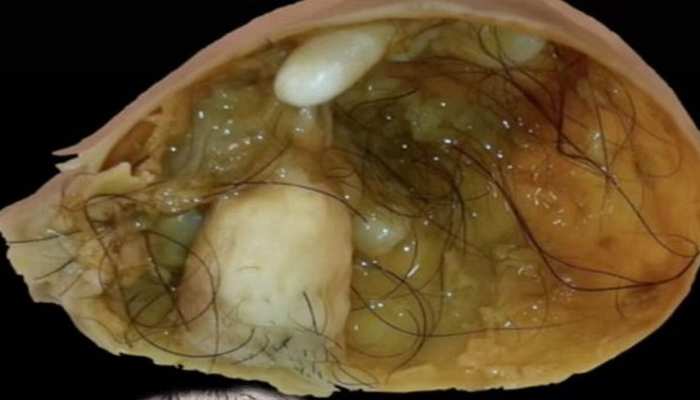 Dermoid Cyst Of The Ovary by Cnriscience Photo Library