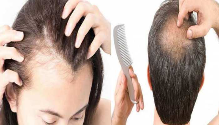 hair fall hair loss treatment, use salt in balanced amount to prevent hair fall | Hair Fall Treatment: कभी नहीं झड़ेंगे सिर के बाल, बस डेली इस एक बात का रखें ध्यान; hair fall hair loss treatment, use salt in balanced amount to prevent hair fall | Hair Fall Treatment: कभी नहीं झड़ेंगे सिर के बाल, बस डेली इस एक बात का रखें ध्यान;