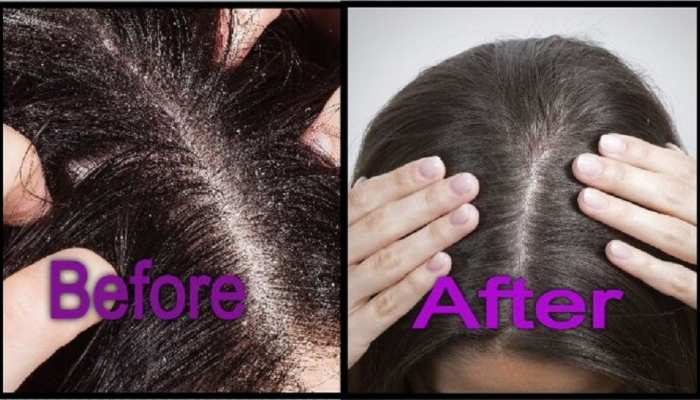 camphor hair oil benefits for hair strong hair tips dandruff cure kapur ke fayde samp | Hair Care TIPS: कपूर से बनाएं हेयर ऑयल, बाल हो जाएंगे मजबूत, डैंड्रफ-जुएं भी खत्म | camphor hair oil benefits for hair strong hair tips dandruff cure kapur ke fayde samp | Hair Care TIPS: कपूर से बनाएं हेयर ऑयल, बाल हो जाएंगे मजबूत, डैंड्रफ-जुएं भी खत्म |