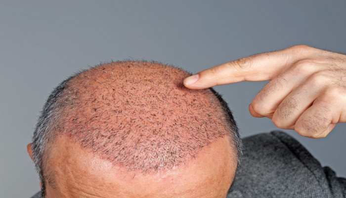 Bihar Policeman died after having Hair Transplant, know Hair Transplant Side Effects | बिहार पुलिस के जवान ने करवाया था हेयर ट्रांसप्लांट, हो गई मौत, जानें वजह | Hindi News, Health Bihar Policeman died after having Hair Transplant, know Hair Transplant Side Effects | बिहार पुलिस के जवान ने करवाया था हेयर ट्रांसप्लांट, हो गई मौत, जानें वजह | Hindi News, Health