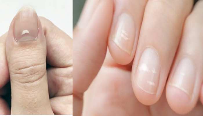 White Marks On Nails Reason | नाखून पर सफेद निशान बनने का क्या मतलब है?  कहीं ये किसी गंभीर बीमारी का संकेत तो नहीं? जानें