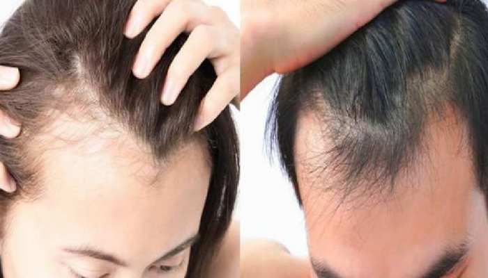 Hair fall problem cause of hair loss treatment how to reduce hair fall stmp | Hairfall: बालों के झड़ने से हैं परेशान तो करें ये आसान उपाय, कभी नहीं टूटेंगे बाल | Hair fall problem cause of hair loss treatment how to reduce hair fall stmp | Hairfall: बालों के झड़ने से हैं परेशान तो करें ये आसान उपाय, कभी नहीं टूटेंगे बाल |