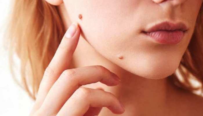 masse meaning on body know what does wart on your body part ...