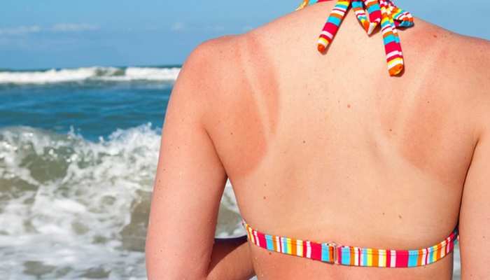 Sunburn से झुलस गया है शरीर, इन 5 उपायों के जरिए Skin Tanning से मिलेगा छुटकारा
