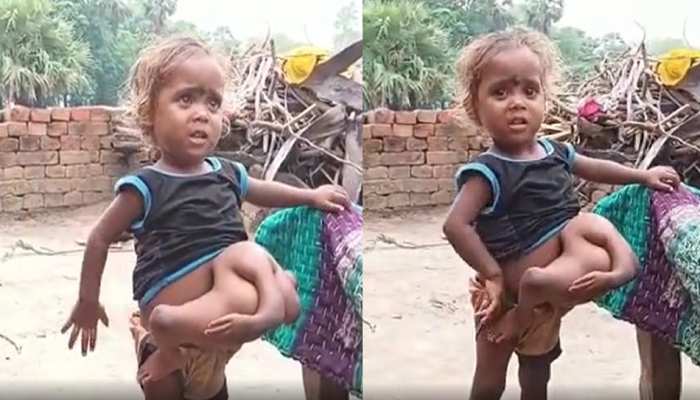 Sonu Sood came forward for the surgery of a unique girl with four hands and four legs in bihar| चार हाथ चार पैर वाली अनोखी बच्ची चहुमुखी कुमारी की सर्जरी के लिए