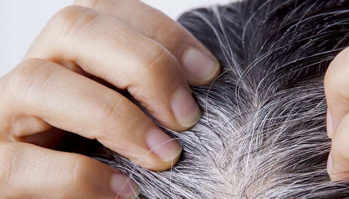 Premature Graying of Hair What Causes White Hair at a Young Age this deficiency of these vitamins | White Hair Problem: आखिर किस वजह से उम्र से पहले ही सफेद होने लगते Premature Graying of Hair What Causes White Hair at a Young Age this deficiency of these vitamins | White Hair Problem: आखिर किस वजह से उम्र से पहले ही सफेद होने लगते