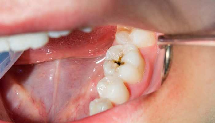 Cavity in Teeth: दांतों में लगे कीड़ों से हैं परेशान, तो इस्तेमाल करें घर में रखी ये