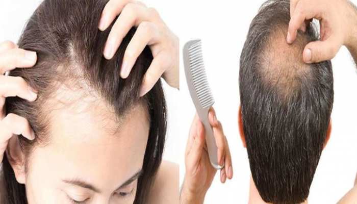 Home Remedy for hairfall solution these hair care tips make your hair strong | Home Remedy: बाल झड़ने से हैं परेशान, इस घरेलू उपाय से बढे़गी बालों की ग्रोथ और मजबूती |