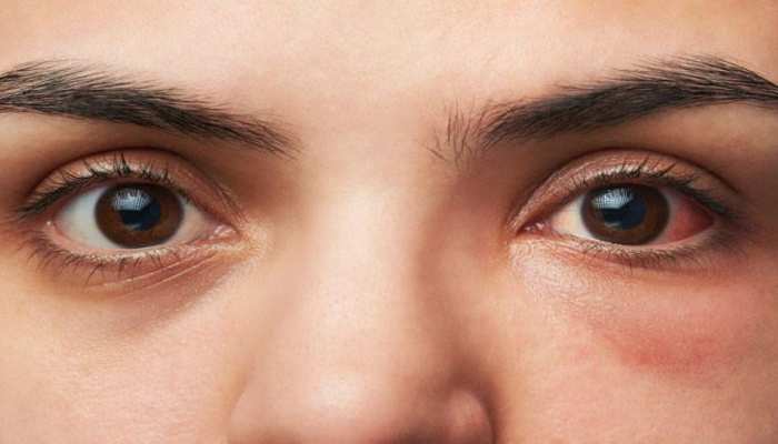 हाई ब्लड प्रेशर के मरीज न करें लापरवाही, आंखों को हो सकते हैं ये बड़े नुकसान