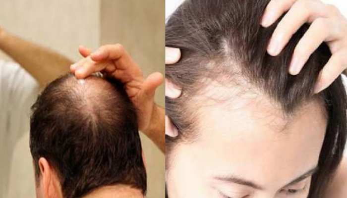Hairfall reason and how to controll hair fall in men and women vitamins for  hairs bal tootne ka karan SMI | Hairfall Reason: कहीं इन इन कारणों से तो  नहीं झड़ रहे