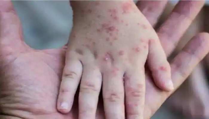 monkeypox virus WHO declared global health emergency india third monkeypox case confirmed in Kerala dadnh | WHO ने मंकीपॉक्स वायरस को घोषित किया ग्लोबल हेल्थ इमरजेंसी, भारत में भी बढ़ा खतरा |
