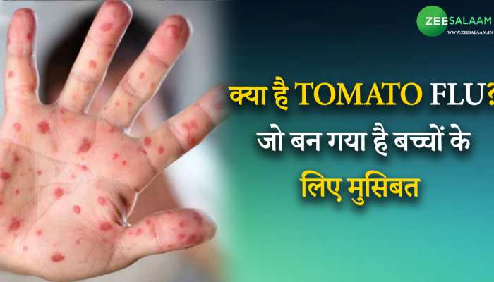 Tomato Virus: क्या है Tomato flu? जो बन गया है बच्चों के लिए मुसिबत का सबब!