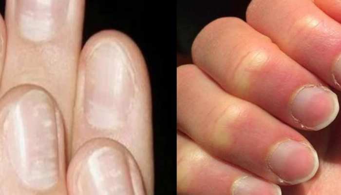 These Symptoms Of Nails Is Sign Of Bad Health - जब नाखून नजर आने लगे ऐसे तो  समझ जाइए सेहत है बिगड़ने वाली, हो जाना चाहिए अलर्ट | Lifestyle News In Hindi