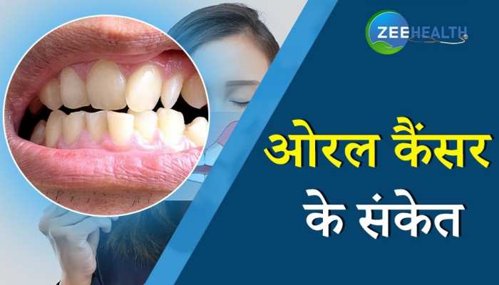 Oral Cancer: जानिए ओरल कैंसर के संकेत और शुरुआती लक्षण