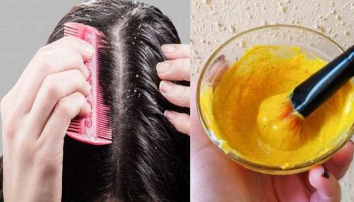 Ayurvedic Hair Care Tips Ayurvedic remedies to stop hair fall | Ayurvedic Hair Care Tips: बालों के झड़ने से परेशान हैं? अपना लें ये 3 आयुर्वेदिक टिप्स, जल्द दिखाई देने लगेगा असर Ayurvedic Hair Care Tips Ayurvedic remedies to stop hair fall | Ayurvedic Hair Care Tips: बालों के झड़ने से परेशान हैं? अपना लें ये 3 आयुर्वेदिक टिप्स, जल्द दिखाई देने लगेगा असर