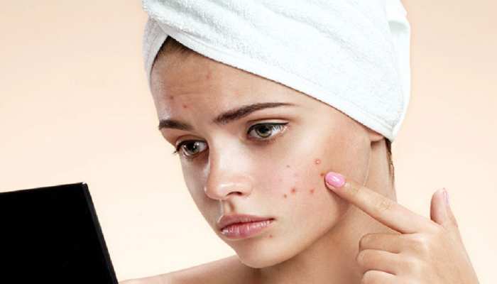 Face acne: पिंपल्स और एक्ने से छुटकारा दिलाएगा दालचीनी, जानें कैसे करें इस्तेमाल