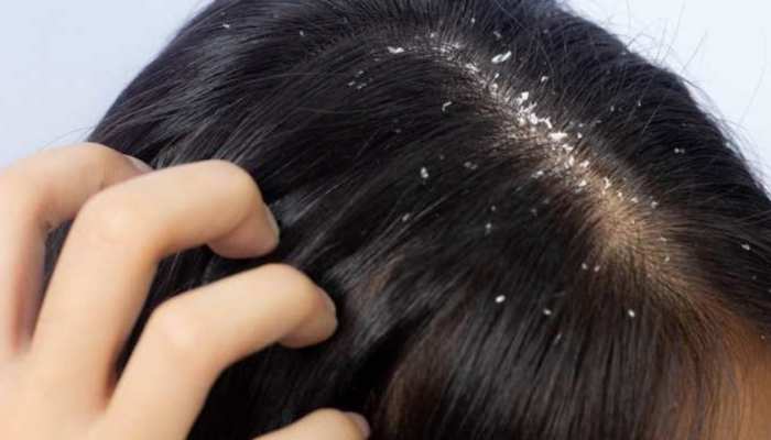 Itching of the head become troublesome follow these home remedies itchy scalp and hair loss | Scalp Itch: दिन-रात सिर खुजाते हो गए हैं परेशान, अपनाएं ये घरेलू नुस्खे; मिल जाएगा आराम| Itching of the head become troublesome follow these home remedies itchy scalp and hair loss | Scalp Itch: दिन-रात सिर खुजाते हो गए हैं परेशान, अपनाएं ये घरेलू नुस्खे; मिल जाएगा आराम|