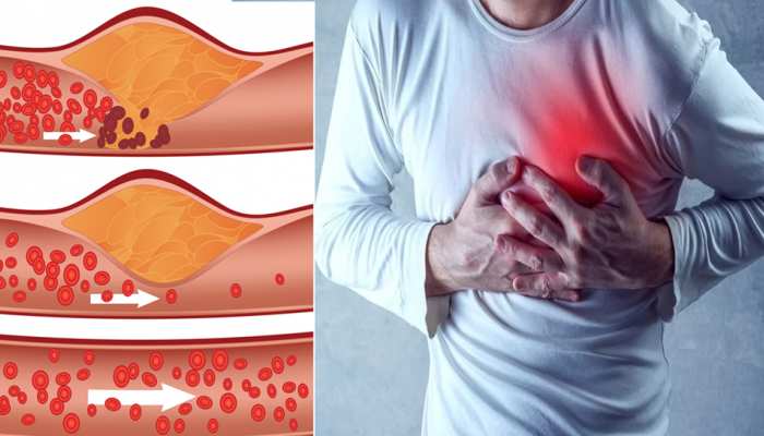 How to reduce cholesterol in home and know more about cholesterol foods SMI  | High Cholesterol Problem: बैड कोलेस्ट्रॉल पिघल जाएगा मोम की तरह, बस आज से  करनी होंगी ये चीजें |