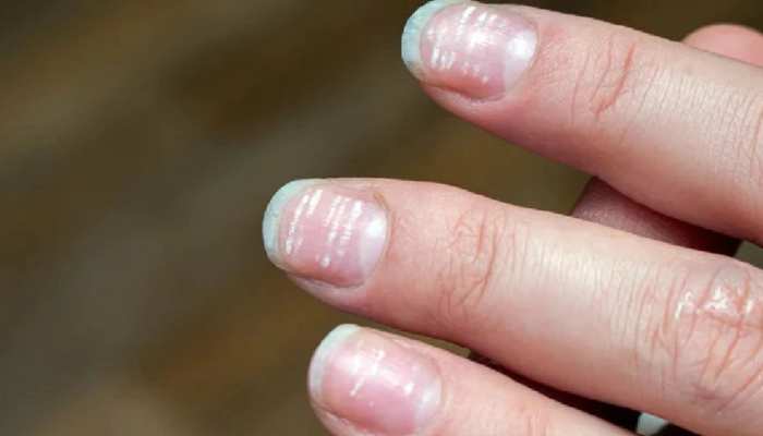 Do not ignore the white spots of nails serious diseases can occur you reason of white spots on nails | White spots on nails: नाखून के सफेद स्पॉट को न करें नजरअंदाज, Do not ignore the white spots of nails serious diseases can occur you reason of white spots on nails | White spots on nails: नाखून के सफेद स्पॉट को न करें नजरअंदाज,