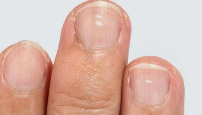 health Tips causes of white marks on nails | Nails Health Tips: नाखूनों पर हो रहे हैं सफेद निशान? ये हो सकते हैं बड़े कारण, हो जाएं सावधान | Hindi News health Tips causes of white marks on nails | Nails Health Tips: नाखूनों पर हो रहे हैं सफेद निशान? ये हो सकते हैं बड़े कारण, हो जाएं सावधान | Hindi News