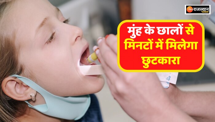 Health Tips : इस घरेलू उपाय से मिनटों में मिलेगा मुंह के छालों से छुटकारा