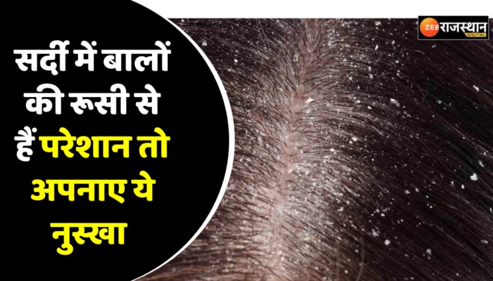 Beauty Tips : सर्दी में बालों की रूसी से हैं परेशान तो काम आएंगे ये उपाय