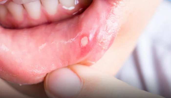 Mouth Ulcers: मुंह के छालों के दर्द से हालत है खराब! इन आयुर्वेदिक उपायों से मिलेगी