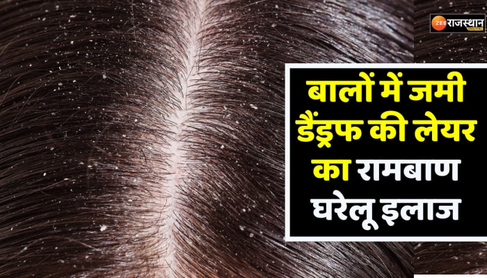 Beauty Tips : मात्र 03 दिन में गायब होगी बालों में जमी डैंड्रफ, इलाज का ये नुस्खा