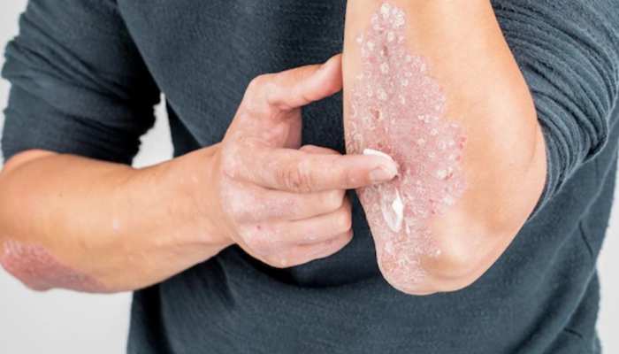 home remedies to get rid of fungal infection skin care health tips | Fungal Infection: खुजली और लालपन है फंगल इंफेक्शन का संकेत! इन नुस्खों से मिल जाएगा छुटकारा | Hindi News, वेलनेस home remedies to get rid of fungal infection skin care health tips | Fungal Infection: खुजली और लालपन है फंगल इंफेक्शन का संकेत! इन नुस्खों से मिल जाएगा छुटकारा | Hindi News, वेलनेस