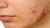  Acne Problem: सालों से चेहरे के मुंहासे नहीं हो रहे हैं खत्‍म, इन चीजों से तुरंत मिलेगा फायदा  