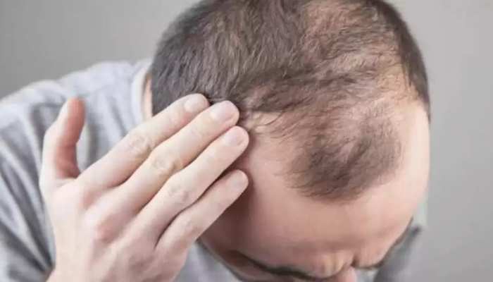 Hair Fall In Men: जानें पुरुषों की कौन सी आदतें बनती हैं गंजेपन की वजह