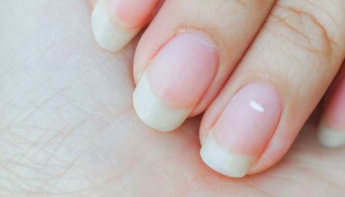 9 Changes in Nails Tell You Need to See a Doctor | 9 changes in nails tell  you need to see a doctor | HerZindagi