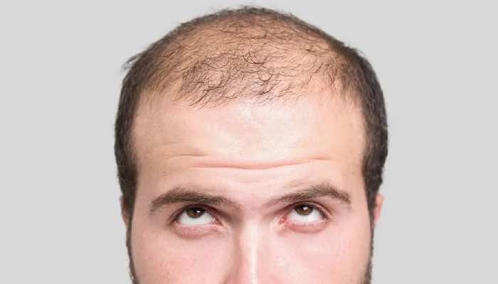 Hair Cut Tips: Know these 5 important things before getting a haircut one single mistake can make you bald | बाल काटने से पहले जान लें ये 5 जरूरी बातें, जरा सी Hair Cut Tips: Know these 5 important things before getting a haircut one single mistake can make you bald | बाल काटने से पहले जान लें ये 5 जरूरी बातें, जरा सी