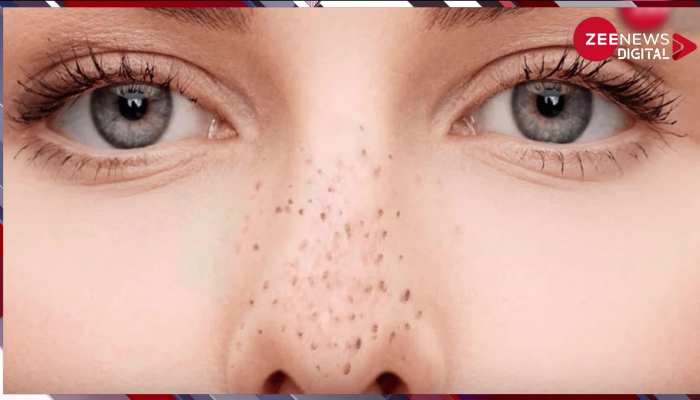 ब्लैकहेड्स से पाना है छुटकारा तो 7 दिन करें ये काम
