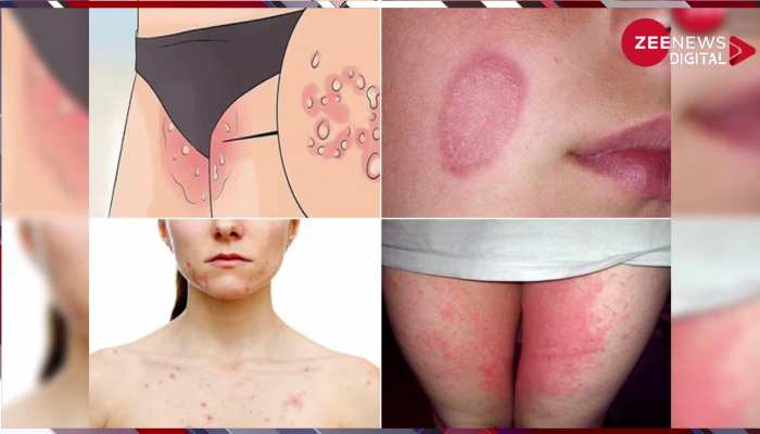 Home Remedies for Ringworm: दाद से हो गए हैं परेशान, तो इन टिप्स के जरिए दूर करें फंगल इंफेक्शन