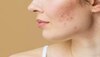 Pimple Marks: पिंपल का जिद्दी निशान होगा छूमंतर, ट्राई करें ये घरेलू नुस्खे