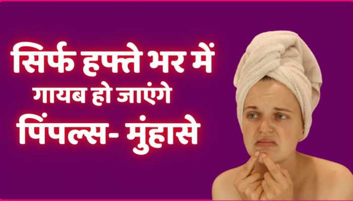 Beauty tips : आजमाए ये घरेलू नुस्खा , हफ्ते भर में गायब हो जाएंगे पिंपल्स- मुंहासे 