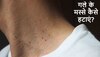 Neck Warts: गले के मस्से बिगाड़ रहे हैं खूबसूरती, बिना दर्द और परेशानी के घर में हटाएं Skin Tags