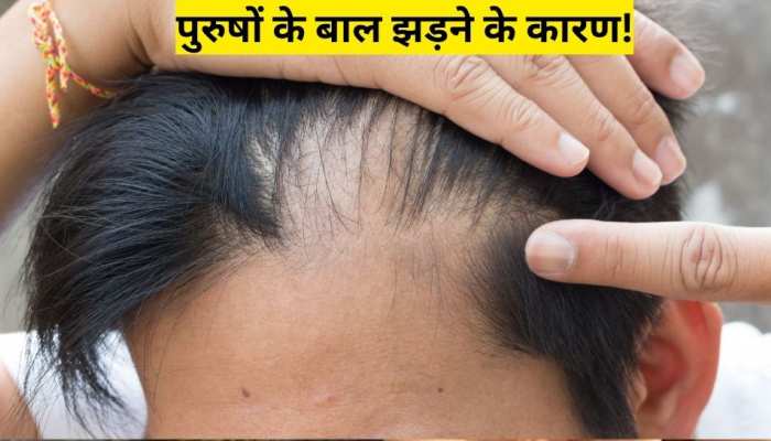 What Are The Causes Of Hair Fall In Men Hair Fall Solution For Men | Hindi  News, पुरुषों में इन कारणों से झड़ने लगते हैं बाल, ध्यान में रखें ये बातें  कंट्रोल