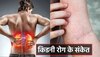 Kidney Disease: स्किन में होने वाली ये 2 समस्याएं देती हैं किडनी रोग के संकेत, तुरंत हो जाएं सतर्क