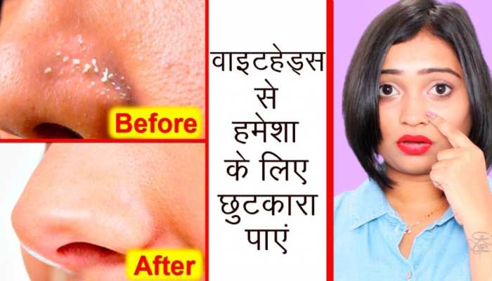 चेहरे पर मौजूद एक-एक Whiteheads जड़ से निकाल देगा ये आसान घरेलू नुस्खा