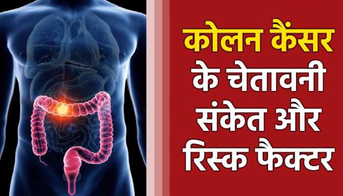 Colon Cancer: युवाओं में तेजी से बढ़ रहा कोलन कैंसर; जानिए संकेत और रिस्क फैक्टर