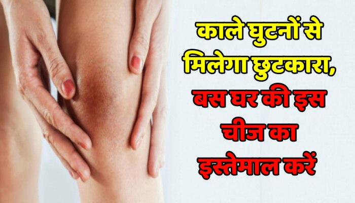 Beauty Tips : काले घुटनों से मिलेगा छुटकारा, बस घर की इस चीज का इस्तेमाल करें