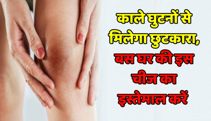 Beauty Tips : काले घुटनों से मिलेगा छुटकारा, बस घर की इस चीज का इस्तेमाल करें 