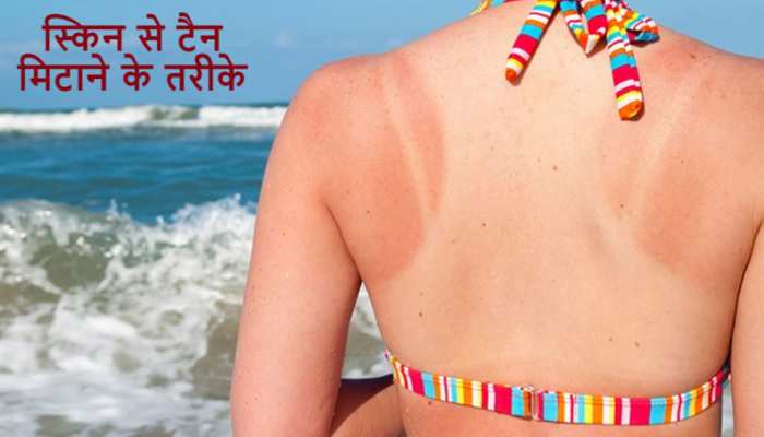 Skin Tanning: तेज धूप पड़ने की वजह से स्किन हो गई टैन? ऐसे दूर होगा कालापन