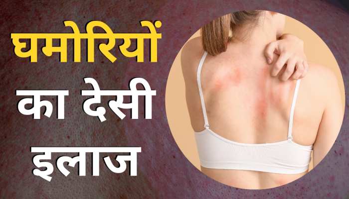 Heat rash: गर्मियों में क्यों निकलती हैं घमोरियां? इन 5 आसान तरीकों से पाएं छुटकारा