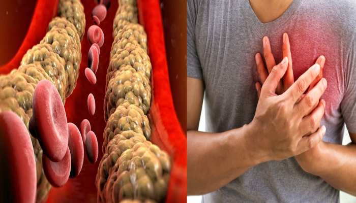 Bad Cholesterol: करनी होंगी ये 5 चीजें, जड़ से खत्म हो जाएगी कोलेस्ट्रॉल की समस्या