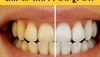 Teeth Cleaning: डेंटिस्ट का खर्च बचाना चाहते हैं आप? इन 5 तरीकों से हटाएं दांतों का पीलापन