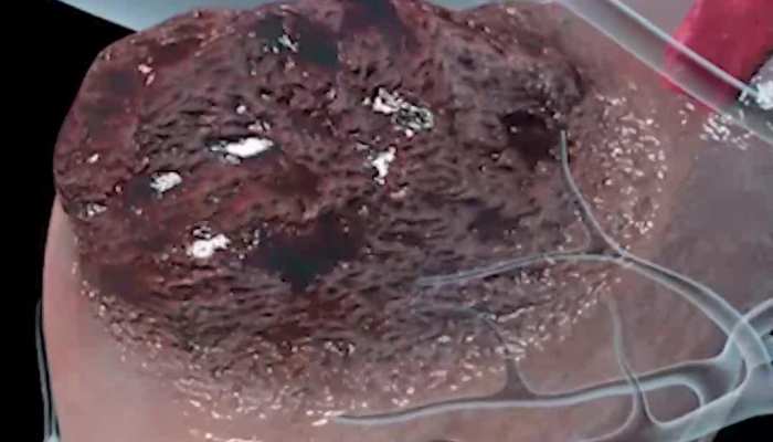 बढ़ रहा है Prostate Cancer का खतरा! इन बातों का रखें खास ध्यान https://english.cdn.zeenews.com/static/apprun/fallbackimages/hindi800x400.svg